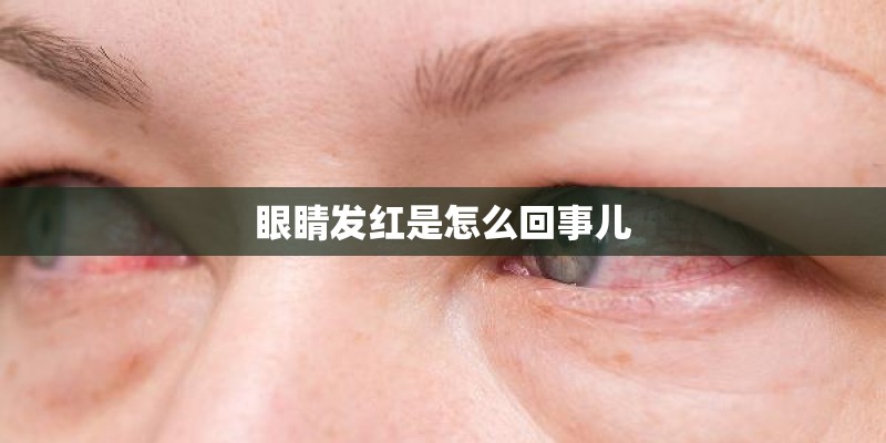 眼睛发红是怎么回事儿 眼睛发红是怎么回事儿