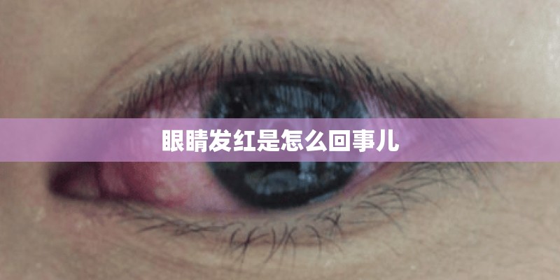 眼睛发红是怎么回事儿 眼睛发红是怎么回事儿